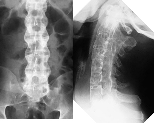 Hình ảnh X quang Bệnh viêm cột sống dính khớp (Bechterew) - Điều Trị Đau  Clinic