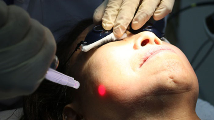 Quy trình kỹ thuật Điều Trị Bằng Laser Công Suất Thấp