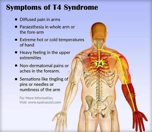 T4-syndrome