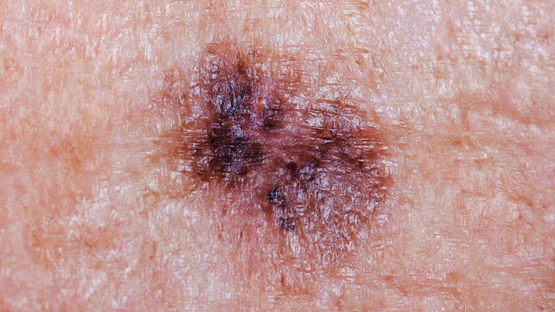 Liệu Pháp "Virus Herpes Diệt Ung Thư" Của Replimune Chính Thức Được FDA Phê Duyệt Sau Nhiều Lần Bị Từ Chối